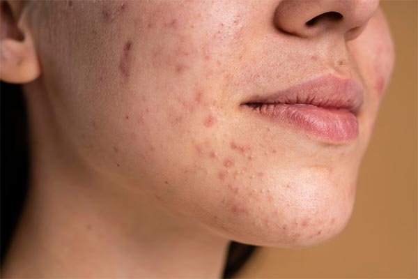 Tratamento para acnes e espinhas