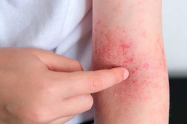 Tratamento para dermatites na pele