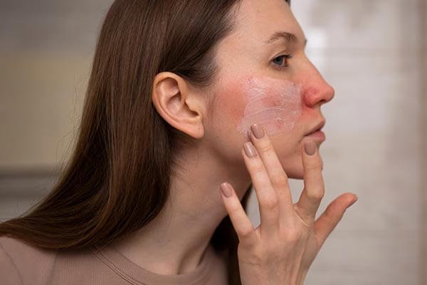 Tratamento para rosácea